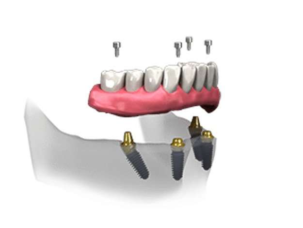 All-on-four and All-on-X implant bridge