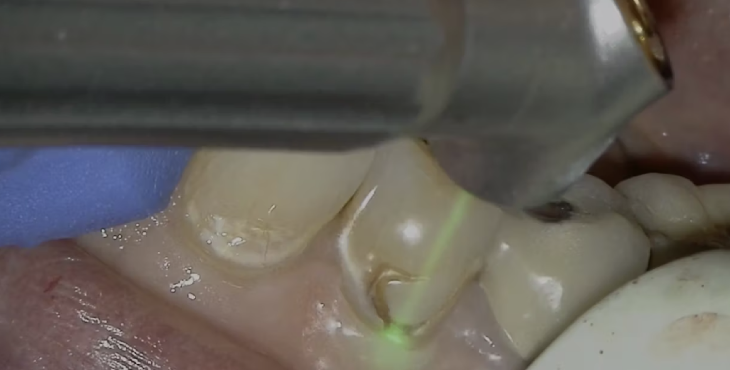 Anesthesia-free cavity treatment with Solea