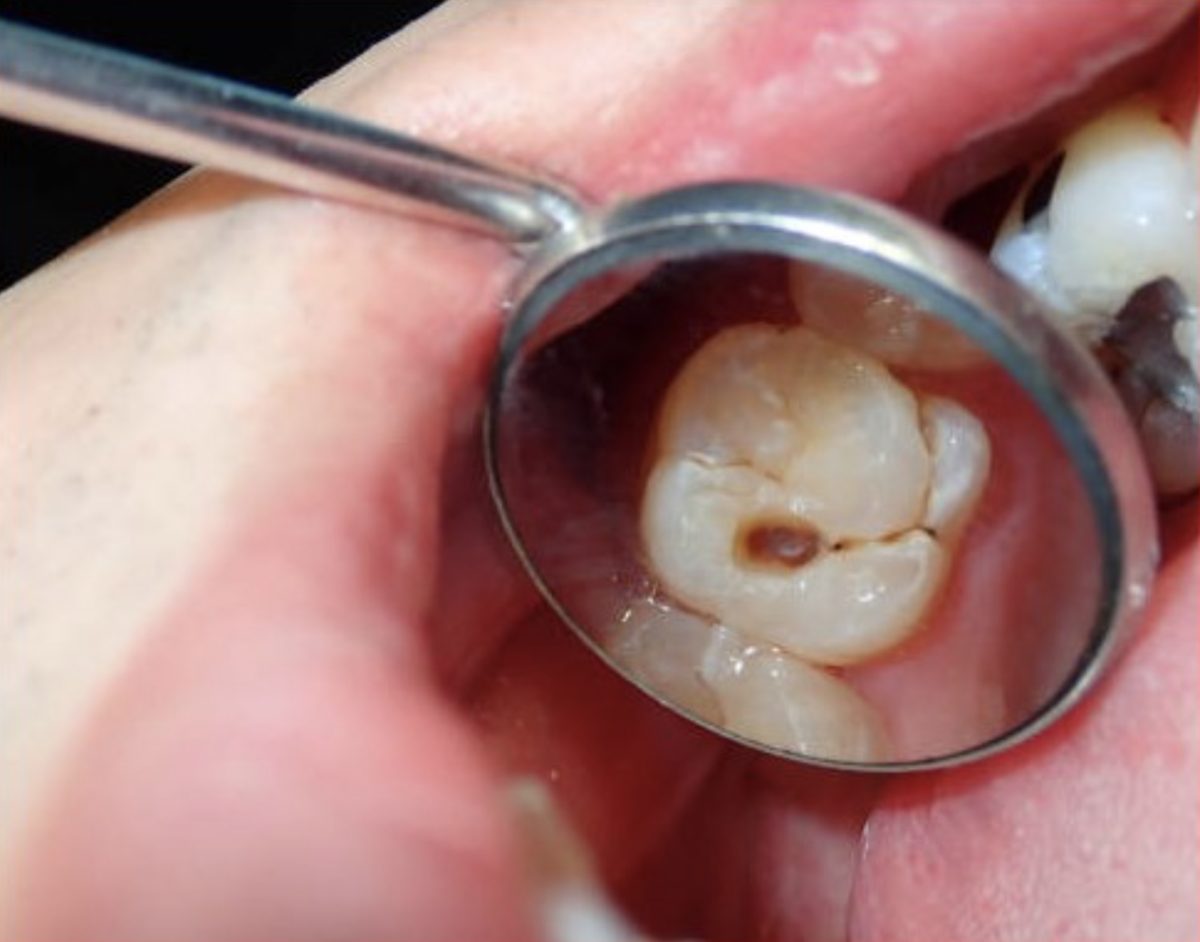 Close-up of a tooth cavity seen through an intraoral dental mirror during NIRI cavity detection