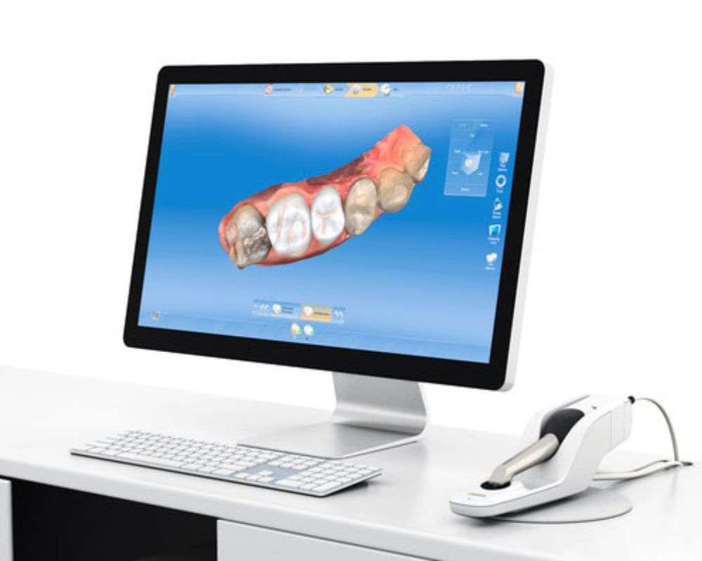 Cerec AI computer designing same-day ceramic crowns