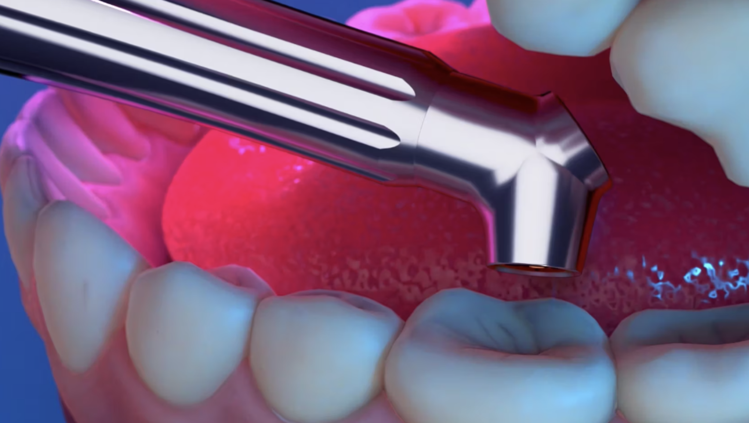Solea Protect prevents enamel mineral loss