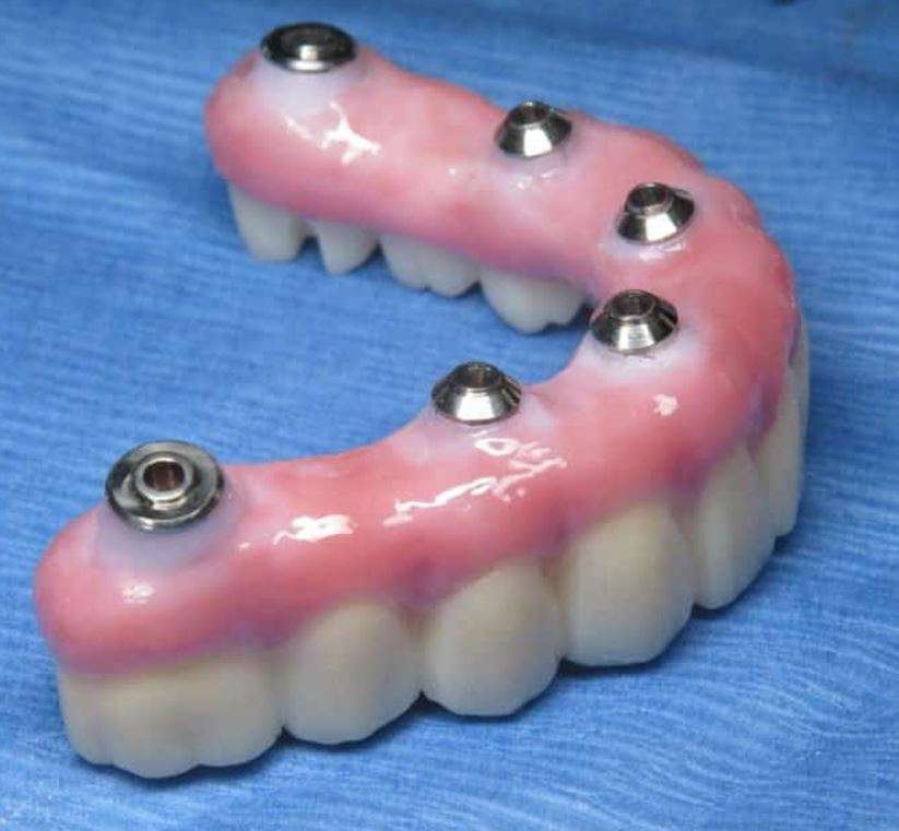 Final AOX zirconia implant bridge