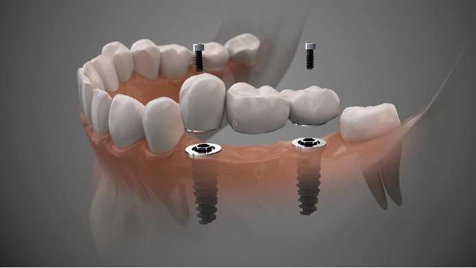 Fixed implant bridge