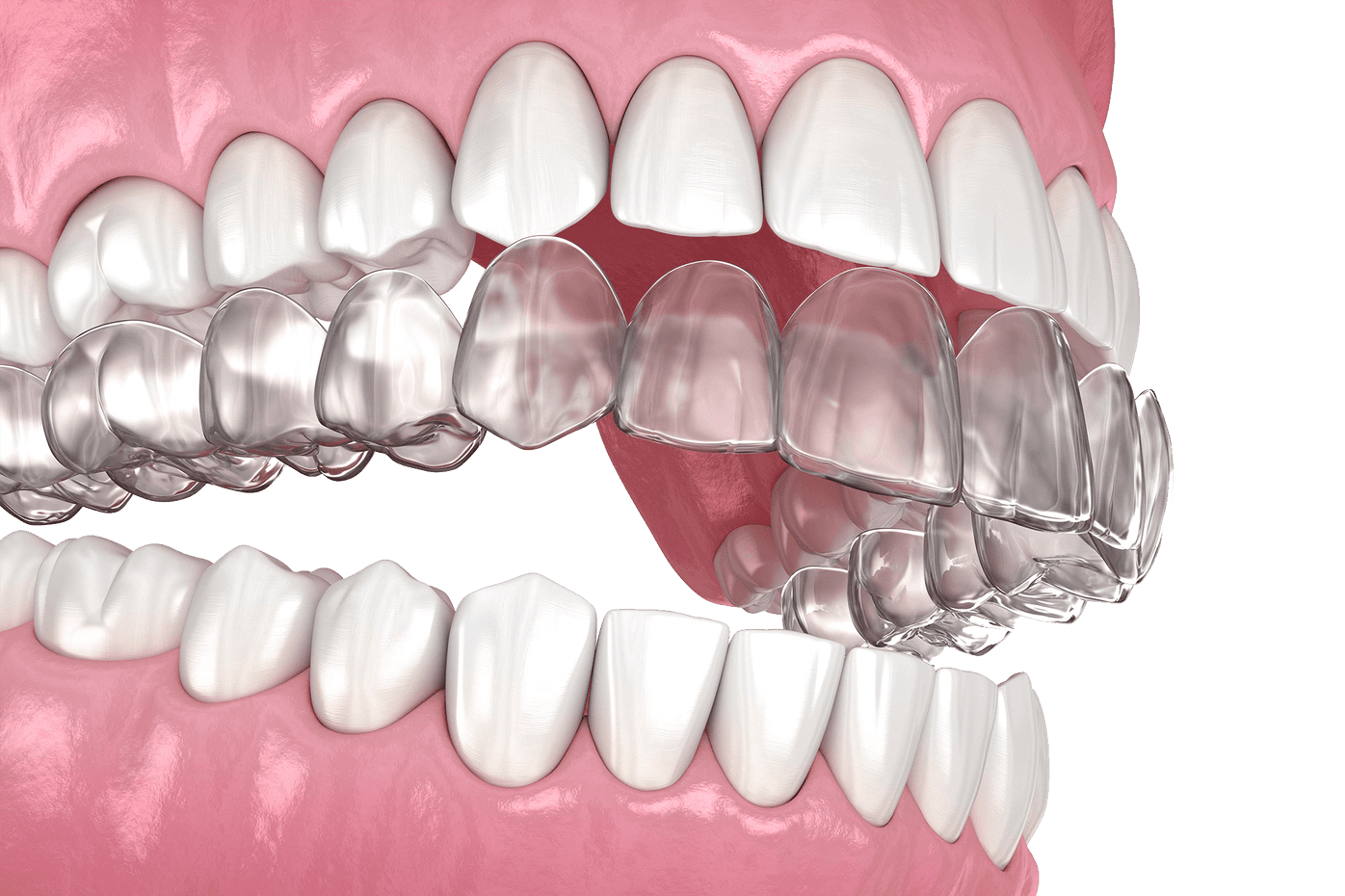 Invisalign vs braces comparison