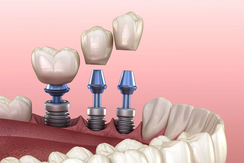 Implant restoration at Centre Dental