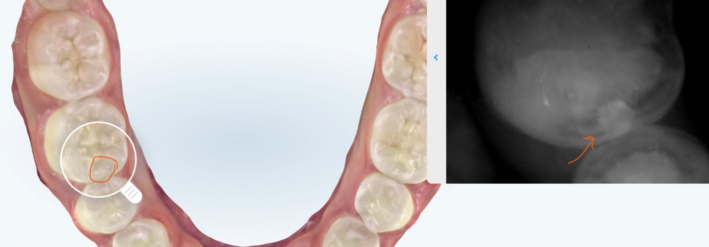 Interproximal cavities between teeth