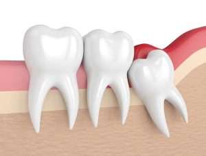 Wisdom tooth removal NYC