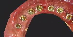 Multiunit abutments