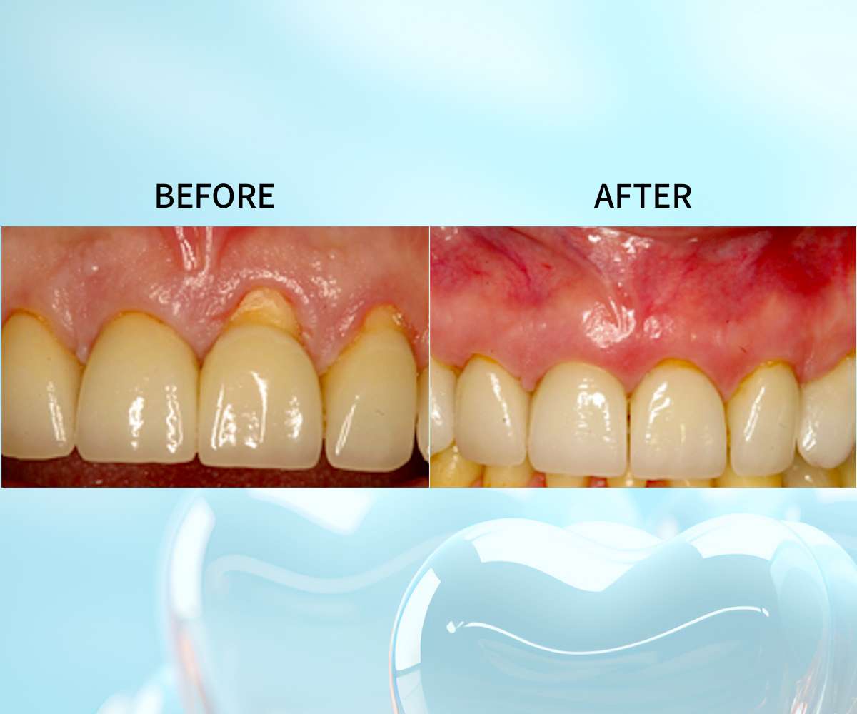 Pinhole gum rejuvenation NYC