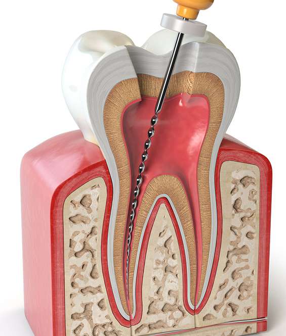 Root canal treatment in NYC