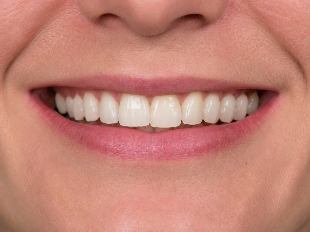 Dental implant after — restored complete smile at Centre Dental NYC