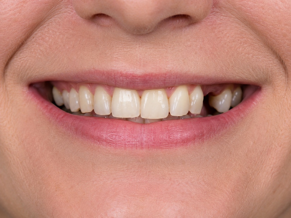 Dental implant before — missing and worn teeth at Centre Dental NYC