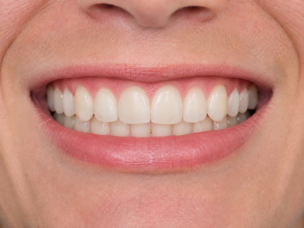 Invisalign after — straightened, aligned smile at Centre Dental NYC