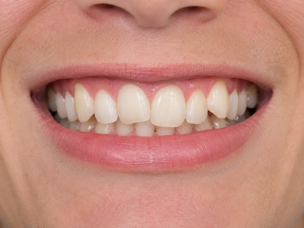 Invisalign before — crowded, misaligned teeth at Centre Dental NYC