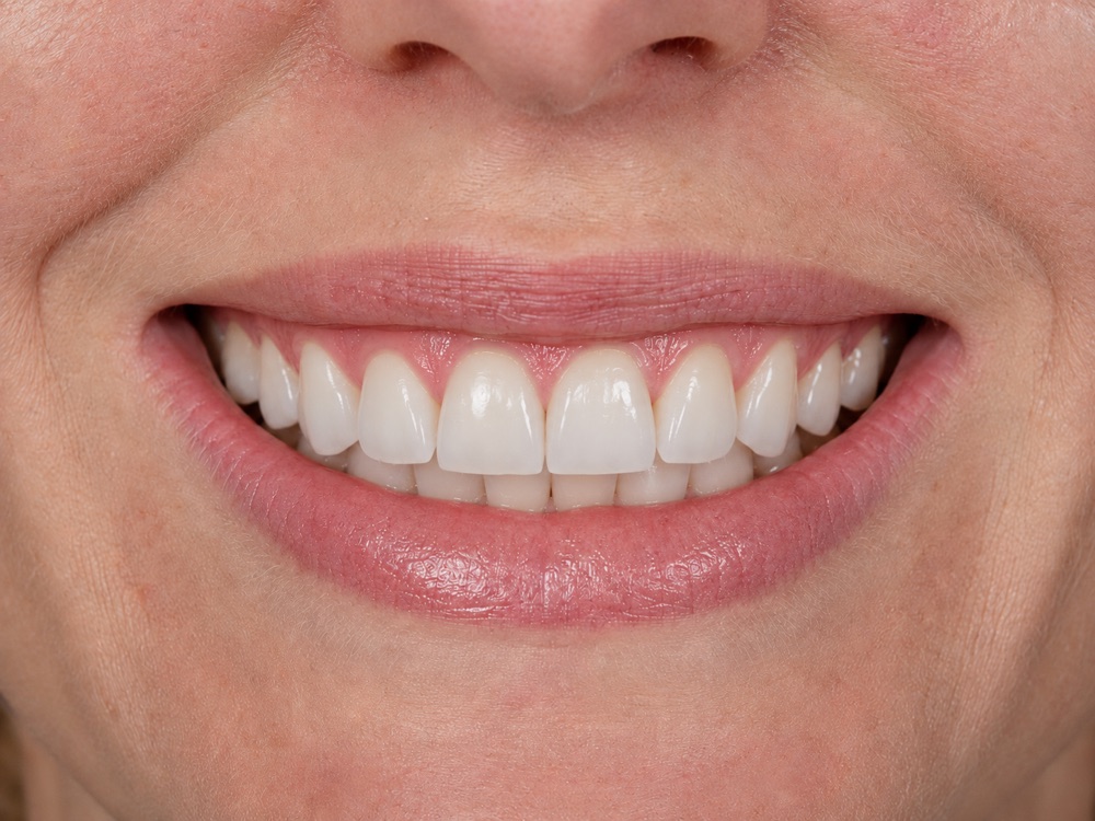 Porcelain veneers after — bright, even smile makeover at Centre Dental NYC