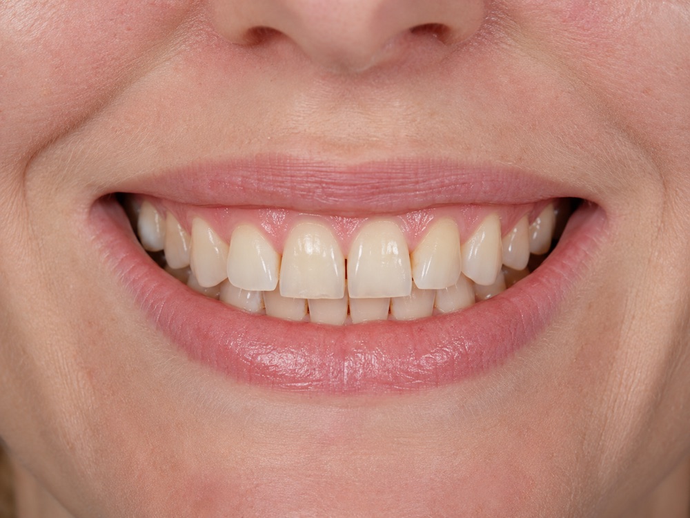 Porcelain veneers before — discolored, uneven front teeth at Centre Dental NYC