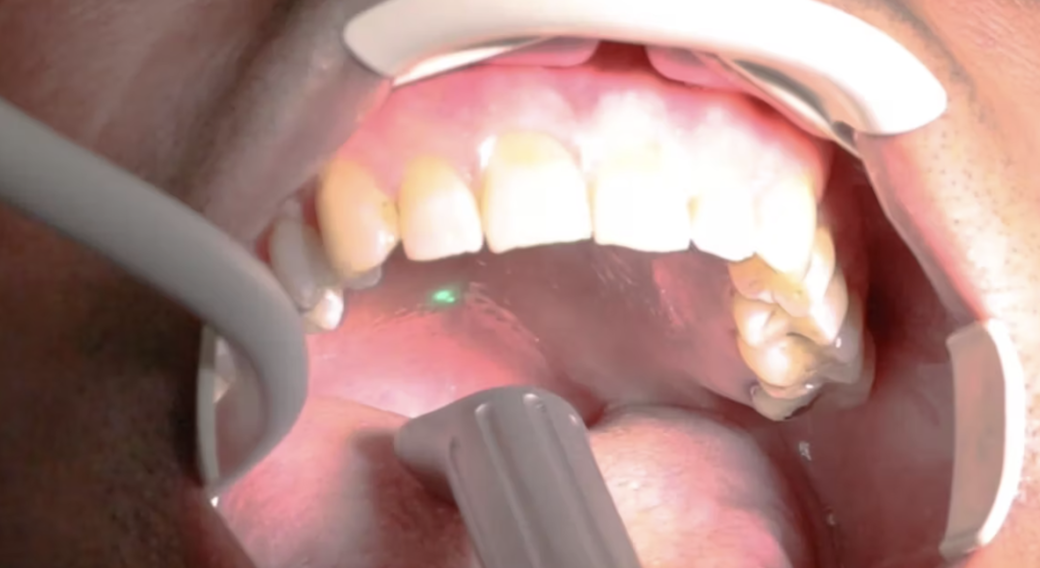 Solea Sleep laser snoring treatment