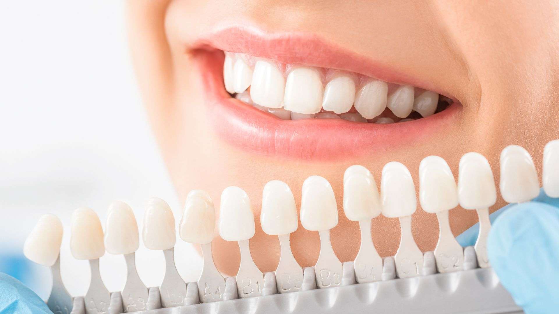 Professional teeth whitening NYC