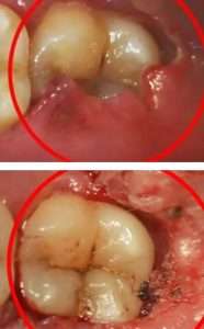 Wisdom tooth treatment process