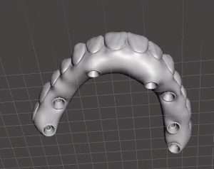 Walk out with a fixed implant bridge
